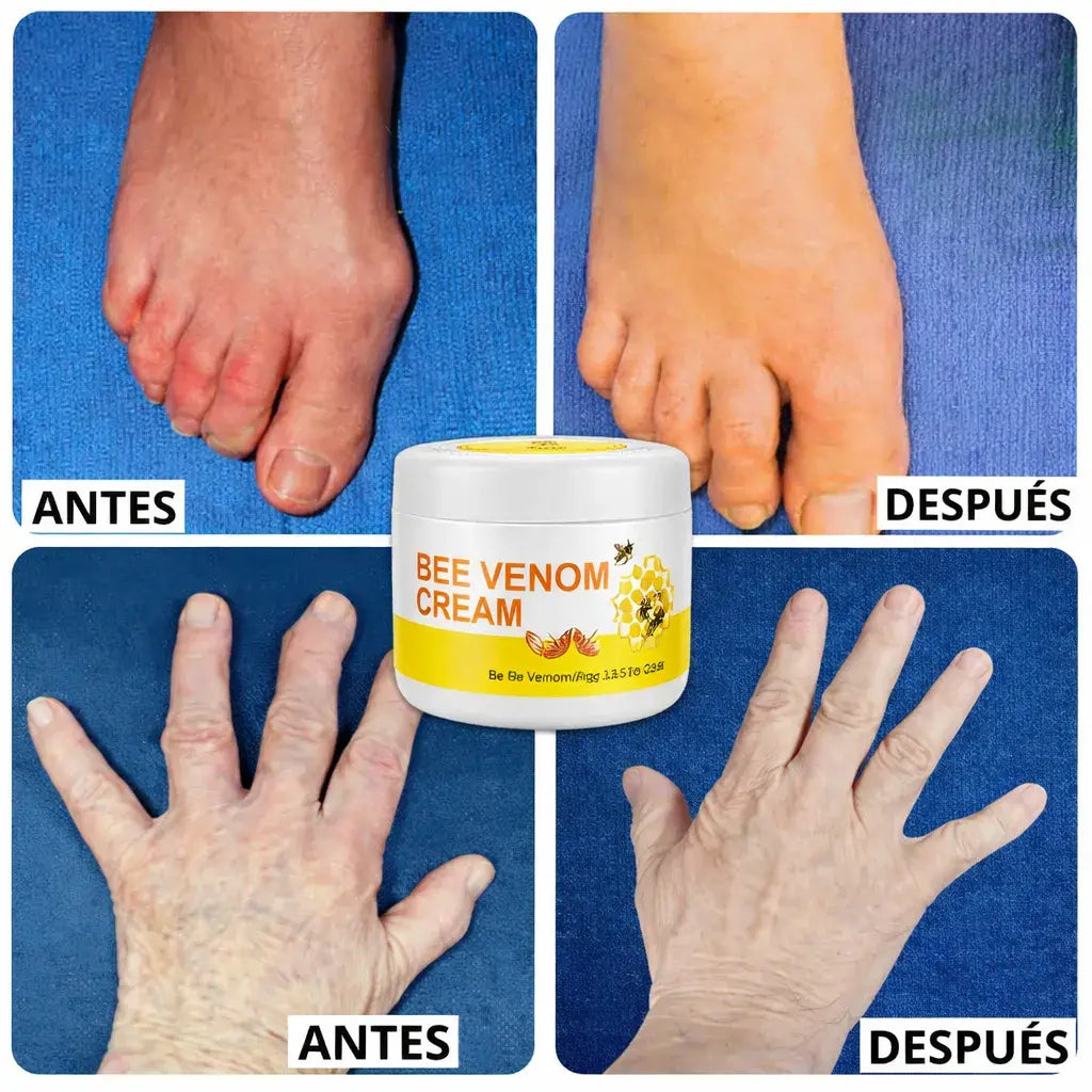 Venom cream Alivia dolores, desinflama y mejora deformaciones Oseas🎁 HOY 30%DCTO