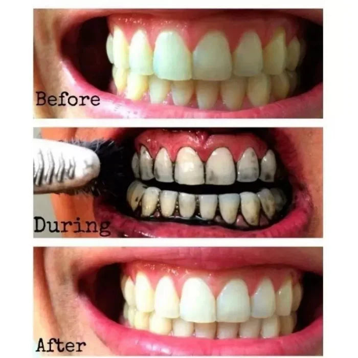 Blanqueador Dental de Lujo con Carbón Activado – Sonrisa Radiante en 3 Días + Aliento Fresco