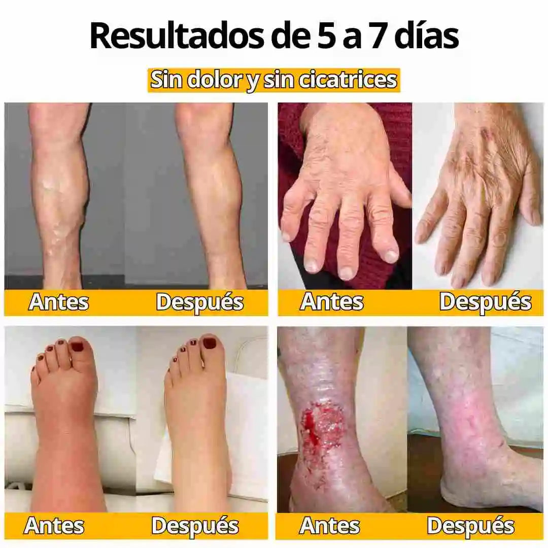 Venom cream Alivia dolores, desinflama y mejora deformaciones Oseas🎁 HOY 30%DCTO